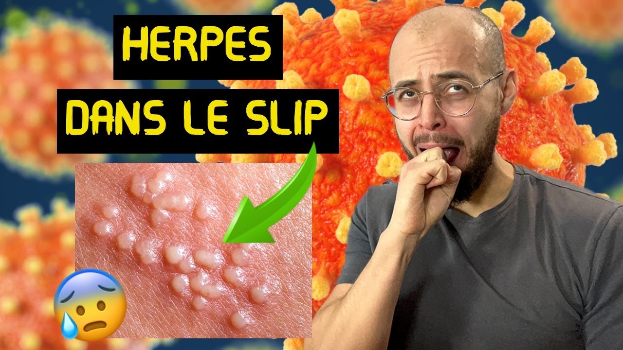 HERPES GENITAL : 5 signes pour le reconnaitre !
